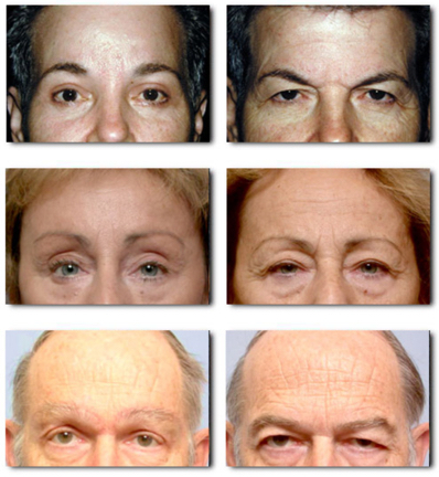 eyelid surgery pictures
